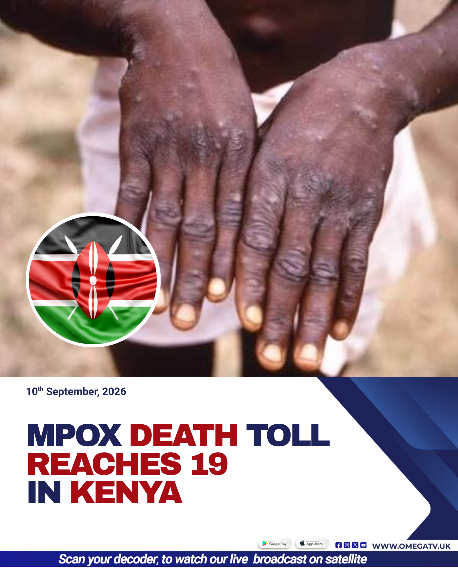 Mpox Death Toll Reaches 19 In Kenya